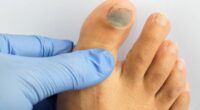 Fungal nail infection symptoms include discolouration of nails, expert warns
