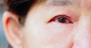Glaucoma symptoms could include 'sudden' redness in eyes