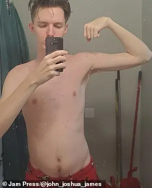Gym buff, 20, left unable to sit down after drugs caused his back to break out in severe acne
