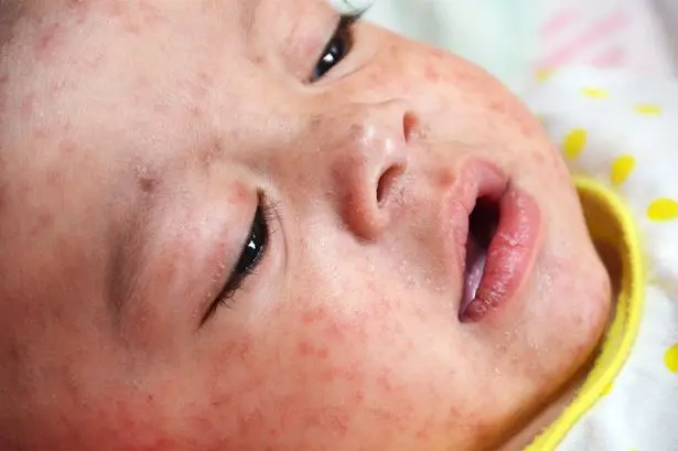 Measles symptoms after outbreak in 17 European countries and WHO warning