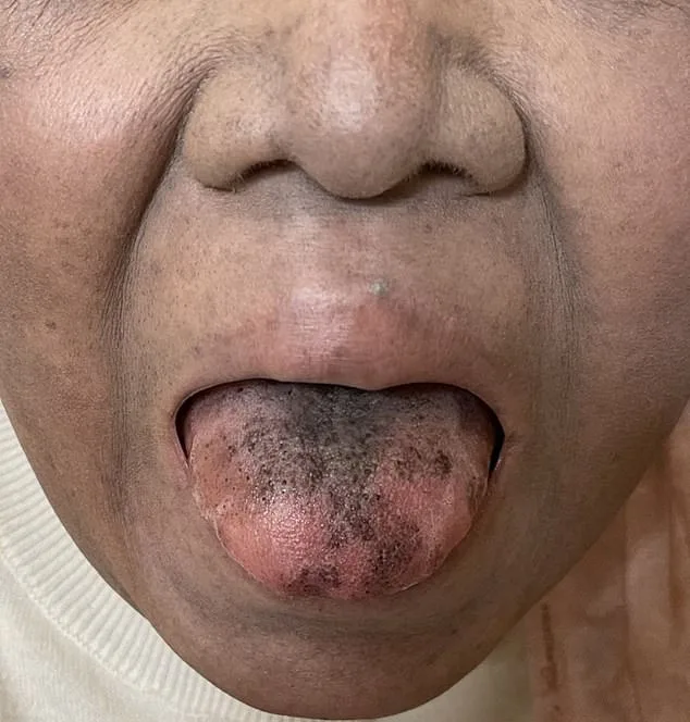 Patient’s tongue turns ‘BLACK and hairy’ because of rare reaction to a common antibiotic