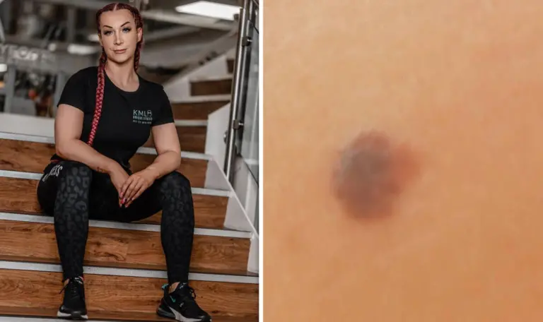 Woman diagnosed with melanoma after mum spotted mole on her back