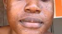 Regina Quaye, from Ghana, tried to remove baby hairs from her face in November by dry-shaving the peach fuzz off with a face razor. Three days later, a nightmare ensued as the 24-year-old's face broke out in acne and became painful and swollen