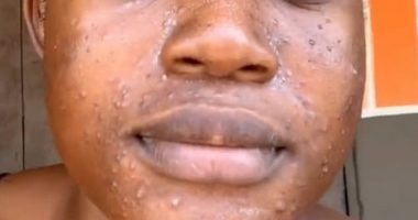 Regina Quaye, from Ghana, tried to remove baby hairs from her face in November by dry-shaving the peach fuzz off with a face razor. Three days later, a nightmare ensued as the 24-year-old's face broke out in acne and became painful and swollen