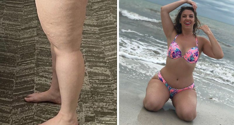 Lipoedema caused woman to have 6.5 litres of fluid drained from legs