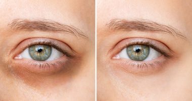 This Eye Cream Reduces the Size and Color of Persistent Dark Circles