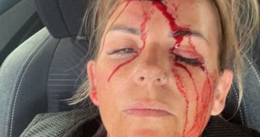 Yorkshire police officer shares picture of horrific injury after she's hurt trying to arrest man
