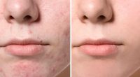 You Have to See the Before-and-After Snaps of This Cystic Acne Treatment