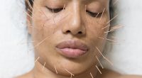I Treated Myself to the Ultimate Luxury Session With London’s Leading Cosmetic Acupuncturist
