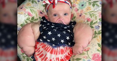 Newborn baby in Kentucky is dubbed 'Mini Hulk' after lymphangioma condition left her with bulging arms and torso
