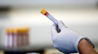 Researchers analyzed protein-encoding genes using blood samples collected from over 17,500 European men with prostate cancer