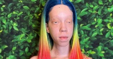 Shaydee Albino Passed Away