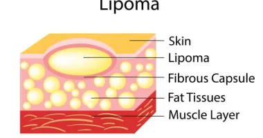Multiple Lipomatosis Syndrome Radiology