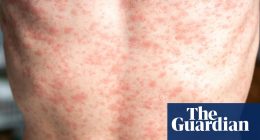 Measles outbreak: how contagious is it and what are the symptoms?