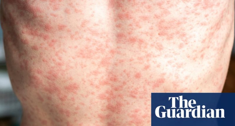 Measles outbreak: how contagious is it and what are the symptoms?