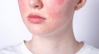 Doctor's guide to fighting rosacea: The cruel unsightly condition can be beaten with little-known treatments that really help, tells DR ELLIE