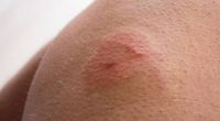 Signs of painful bite 'more severe than mosquito' and how to treat it