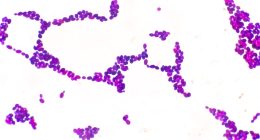 Drug-resistant fungus Candida auris reported in these 17 states