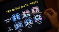 FDA approves blood test that can help diagnose Alzheimer's disease