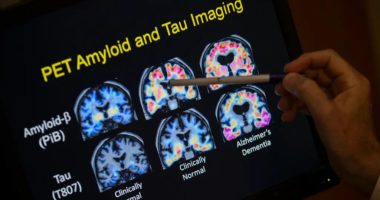 FDA approves blood test that can help diagnose Alzheimer's disease