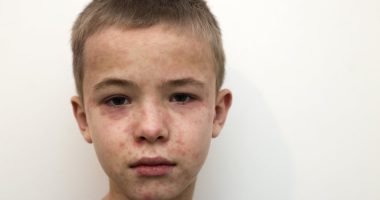 Multi-state outbreak fears as measles hits popular tourist attraction