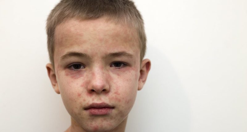 Multi-state outbreak fears as measles hits popular tourist attraction