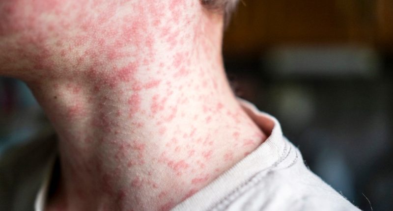 Close-up of measles rash on a person's neck and shoulder.