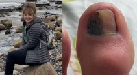 'My doctor told me the mark on my toenail was an infection - but it was cancer'