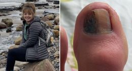 'My doctor told me the mark on my toenail was an infection - but it was cancer'