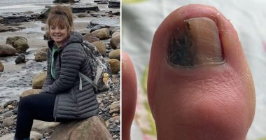 'My doctor told me the mark on my toenail was an infection - but it was cancer'