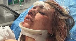 Astonishing wedding day transformation of bride who was beaten bloody in brutal bachelorette party attack