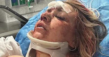 Astonishing wedding day transformation of bride who was beaten bloody in brutal bachelorette party attack