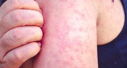 Chicago-area health officials report 2 new measles cases