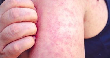 Chicago-area health officials report 2 new measles cases