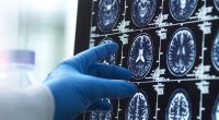 Expert reveals 5 signs of early dementia in your 50s - nothing to do with memory