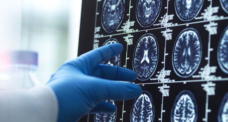 Expert reveals 5 signs of early dementia in your 50s - nothing to do with memory