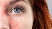 It's a cruel illness that blights the lives of millions. But there's new hope for rosacea patients with this amazing therapy developed to treat cancer