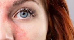 It's a cruel illness that blights the lives of millions. But there's new hope for rosacea patients with this amazing therapy developed to treat cancer