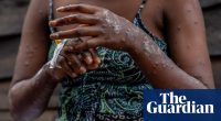 Malawi battles mpox as cases of the infectious disease surge in Africa