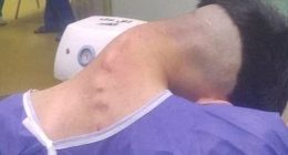 Man, 23, develops shocking 'dropped head syndrome' after battling addiction to one habit for years