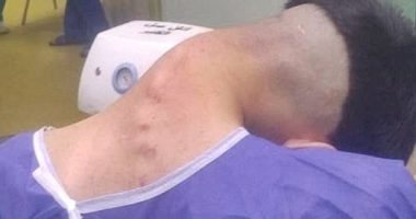 Man, 23, develops shocking 'dropped head syndrome' after battling addiction to one habit for years
