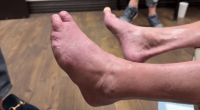 Oklahoma runner loses toes before doctors discover artery blockage