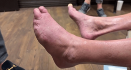 Oklahoma runner loses toes before doctors discover artery blockage