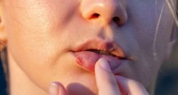 People who suffer from cold sores almost twice as likely to develop ‘silent killer’