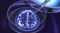SMALL CAP IDEA: Ixico embraces AI for new Alzheimer's treatments