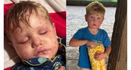 Georgia 2-year-old stung over 150 times by wasps ‘fighting to get better’ after multi-organ failure, family says