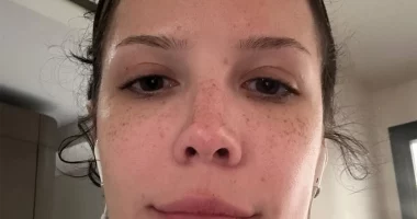 Halsey’s Brave Selfie Reveals Life with Lupus and Rare Disorder: Fans Respond with Support