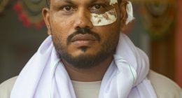 Sole survivor of an Air India plane crash with bandages on his face.