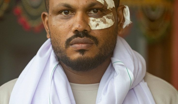 Sole survivor of an Air India plane crash with bandages on his face.