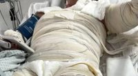 Gabriele Cristine Barreto in a hospital bed with burn bandages.
